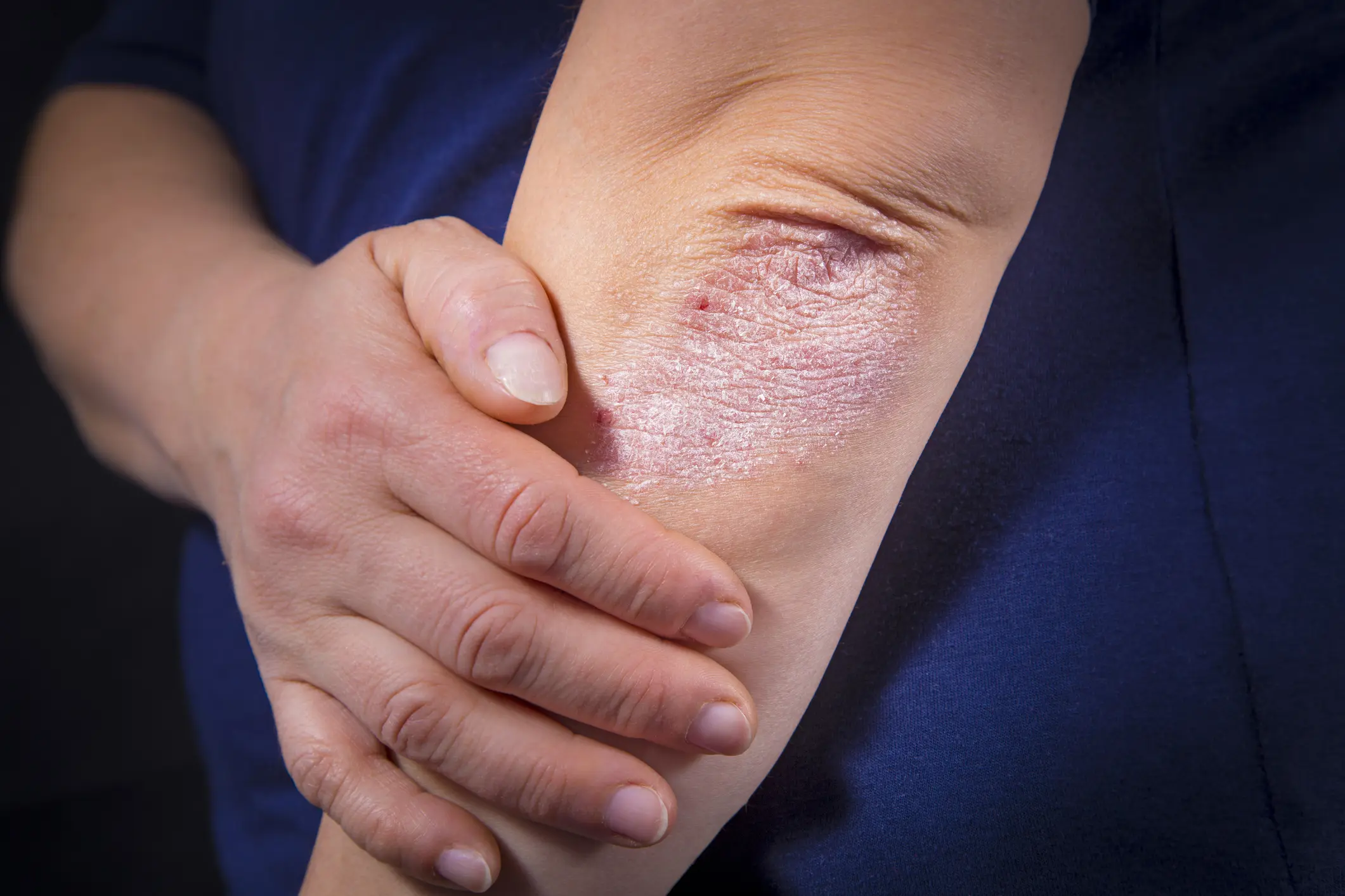 Psoriasis on elbow Psoriasis in Palm Beach, FL