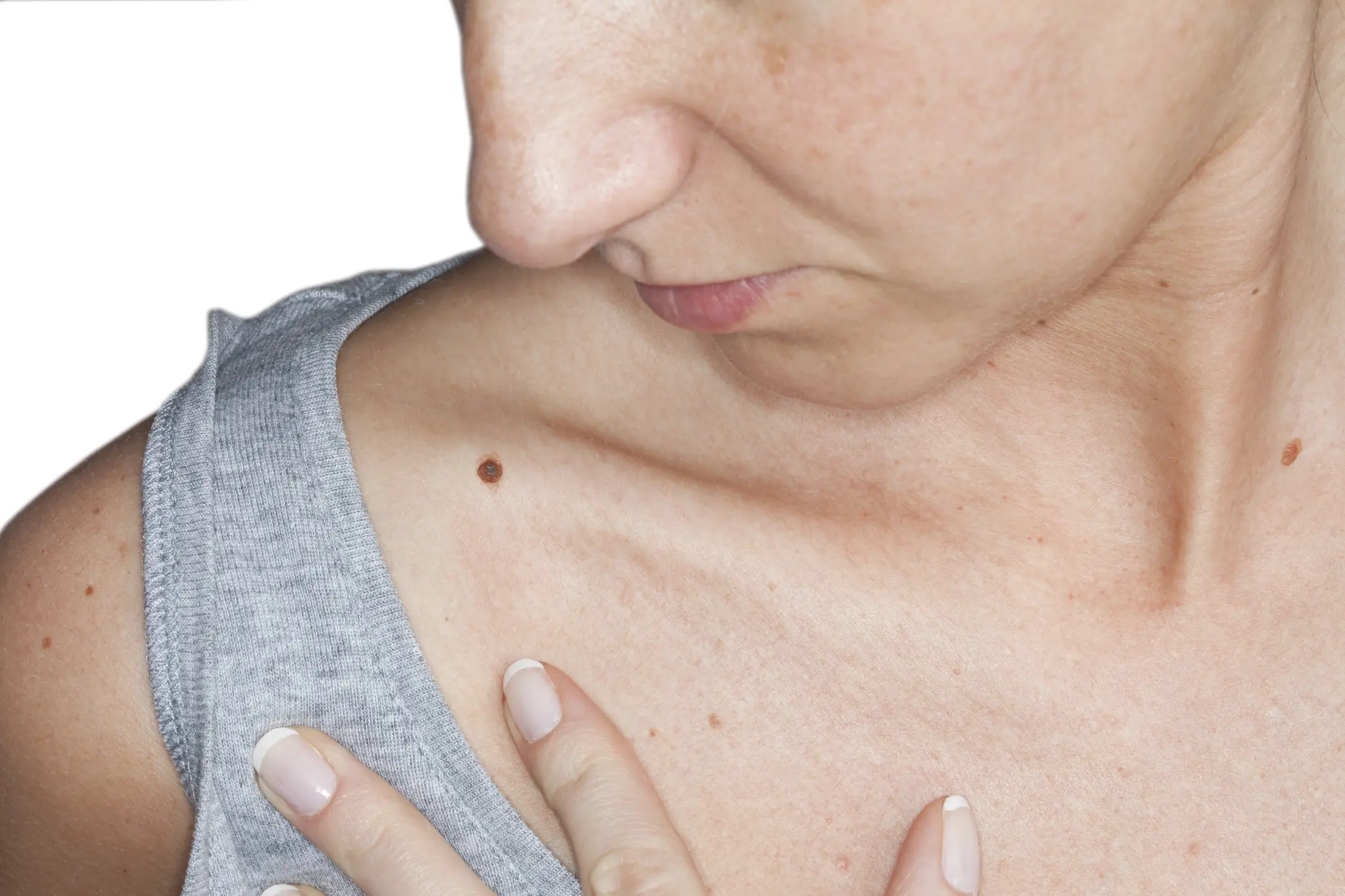 Skin Cancer in Palm Beach, FL
