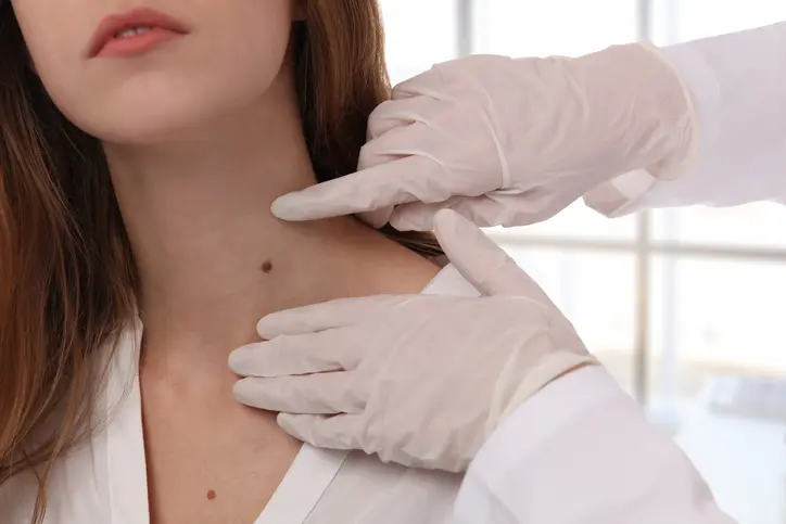 Doctor dermatologist examines birthmark of patient close up. Checking benign moles. Laser Skin tags removal Moles & Warts in Palm Beach, FL