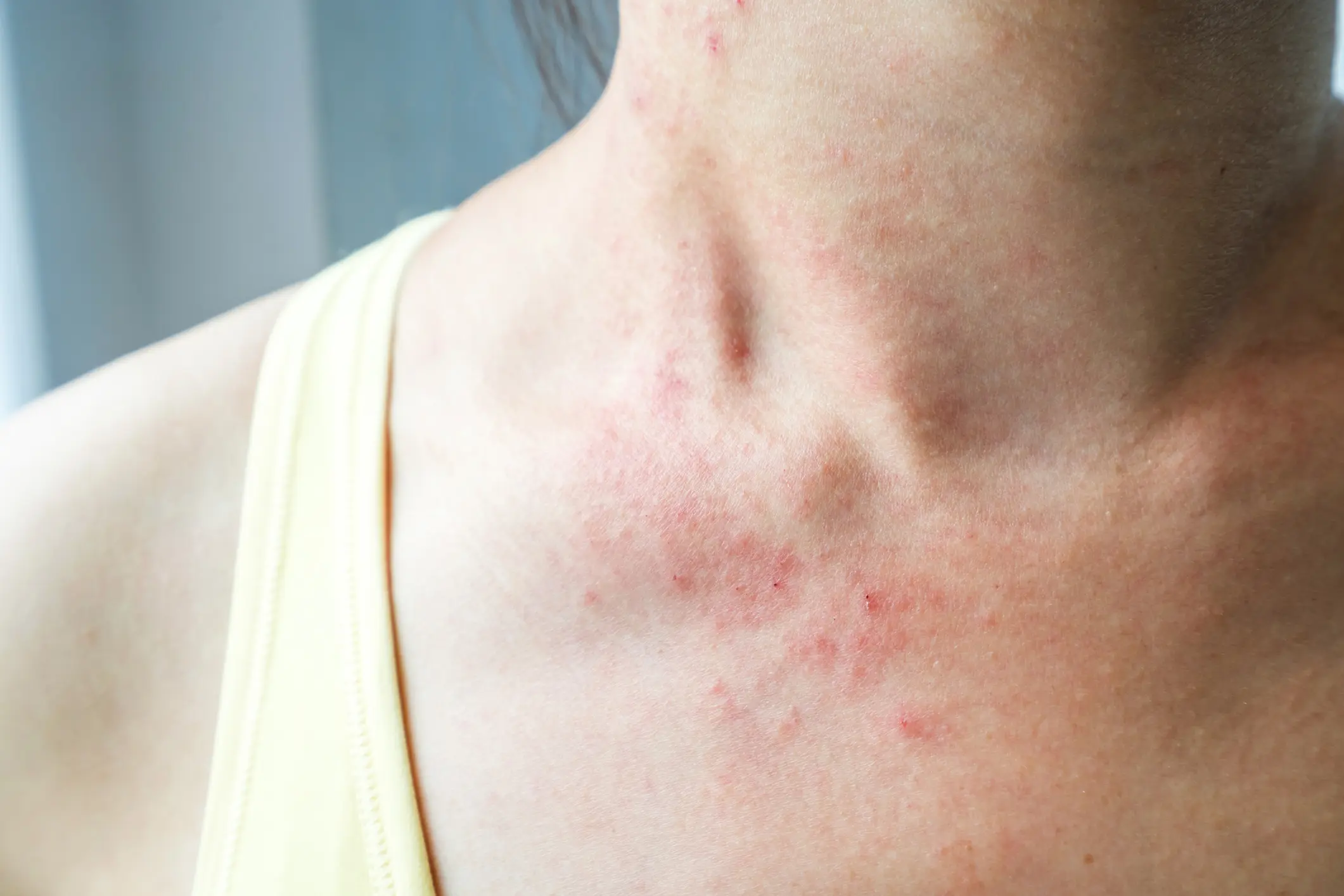 Rashes in Palm Beach, FL