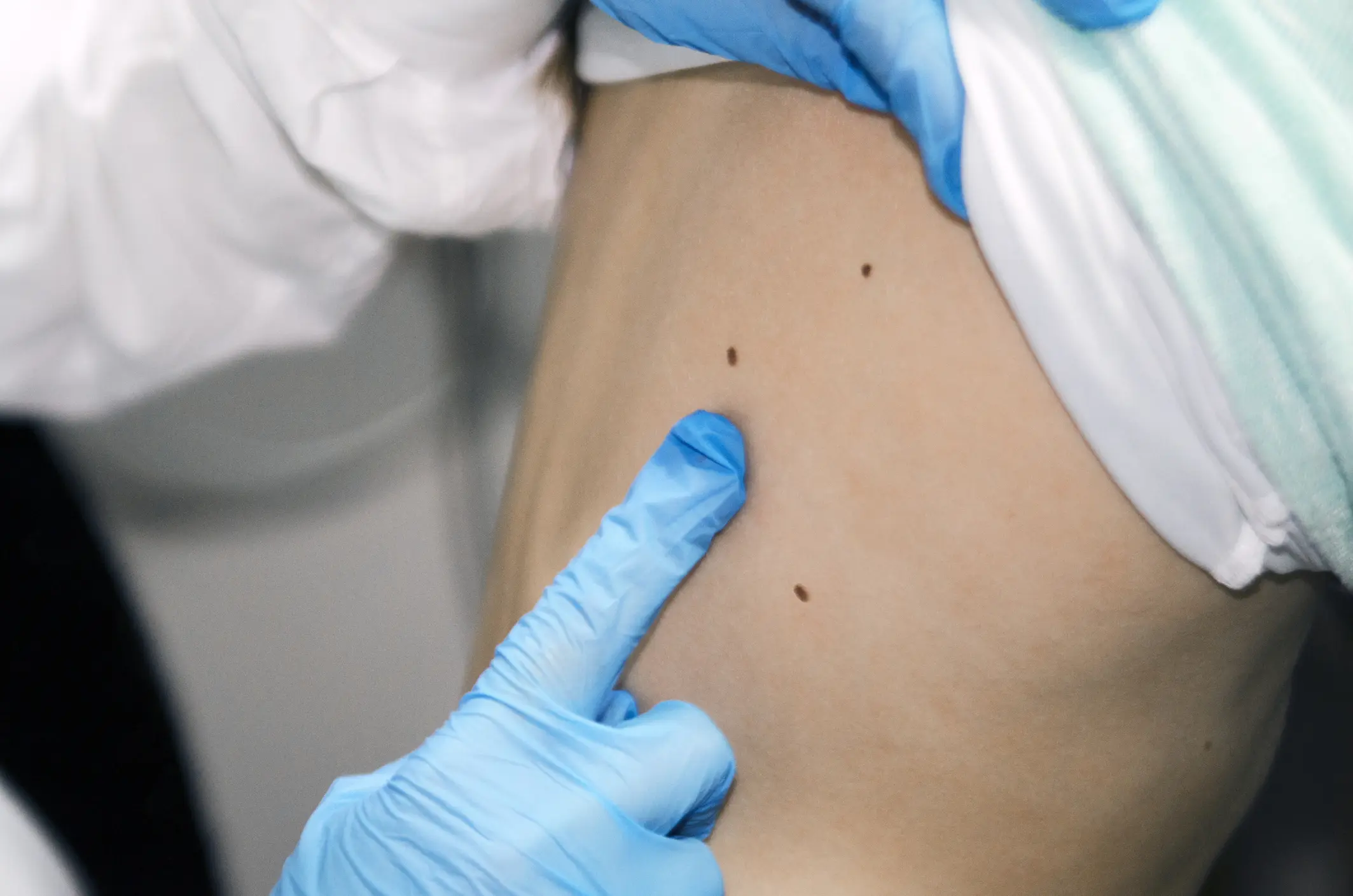 Dermatology examination of child patient back with pigmentation marks.Check and prevent skin problem or cancer disease Skin Check in Palm Beach, FL